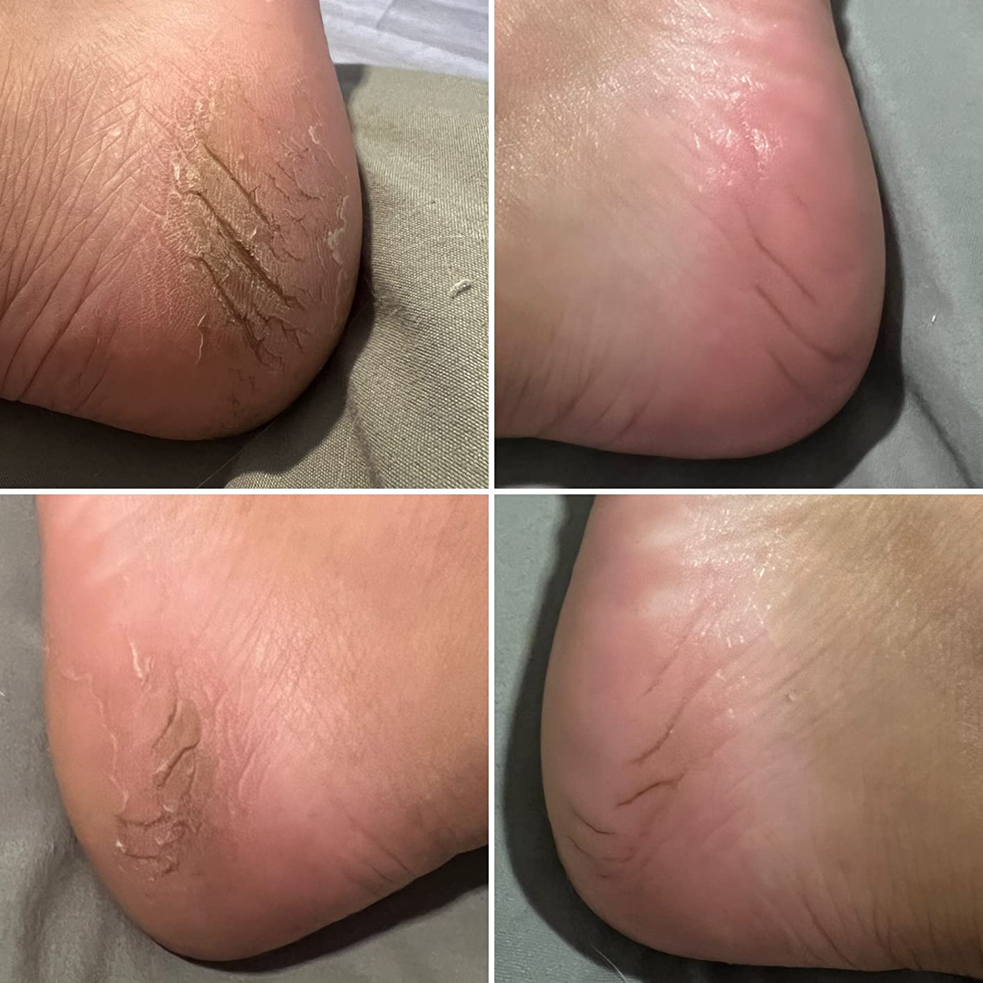 Callus Remover for Feet Shaver Rechargeable Electric Foot File Pedicure Tools for Feet Professional Callous Shaver Waterproof Pedicure kit for Cracked Heels and Dead Skin customer photo 1